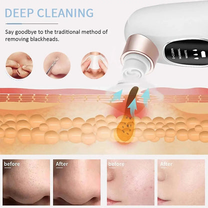 Comparison of skin before and after using hydro facial blackhead remover for deep cleaning.